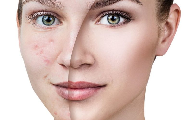 Cilt Lekeleri Nasıl Olur- Cilt Lekelerinin Tedavisinde Doğal Yöntemler Cilt Lekeleri Nasıl Olur- Cilt Lekelerinin Tedavisinde Doğal Yöntemler