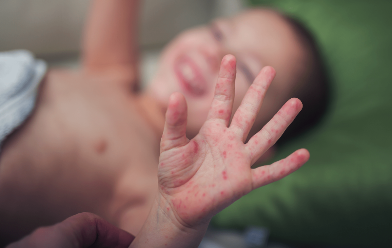 El Ayak Ağız Hastalığı Nedir, Neden Olur? El Ayak Ağız Hastalığı Nedir, Neden Olur?