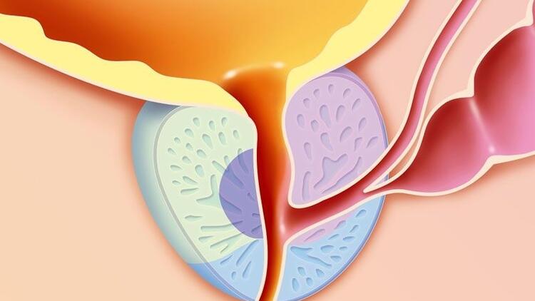 HOLEP cerrahisi Kimler için uygundur? HOLEP cerrahisi Kimler için uygundur?