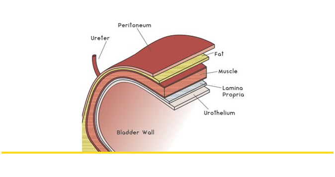 Sinsi ilerleyen bir hastalık: Mesane Kanseri Sinsi ilerleyen bir hastalık: Mesane Kanseri