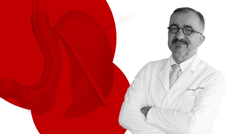 Tüp Mide Ameliyatı Nedir? – Sleeve Gastrektomi Tüp Mide Ameliyatı Nedir? – Sleeve Gastrektomi