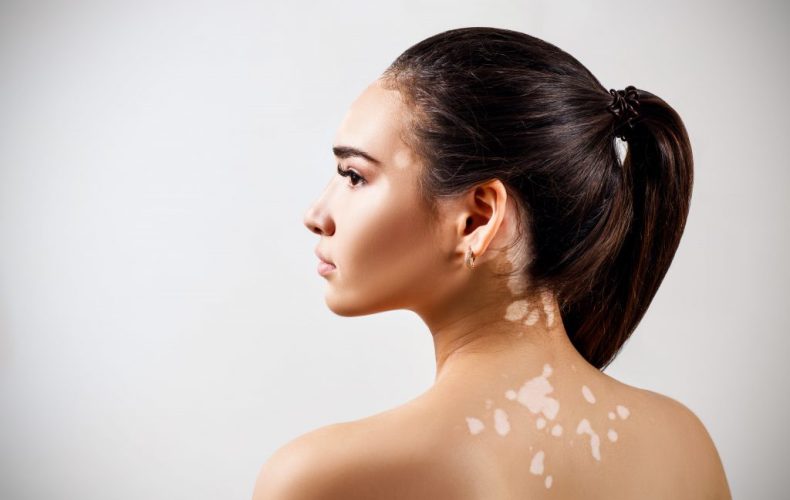 Vitiligo Nedir? Belirtileri Nelerdir? Vitiligo Nedir? Belirtileri Nelerdir?
